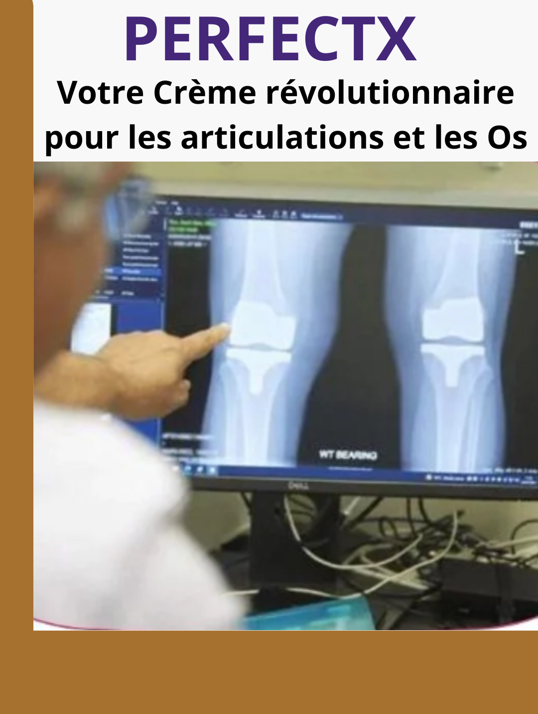 Perfectx : Meilleure solution aux problèmes articulaires et osseux